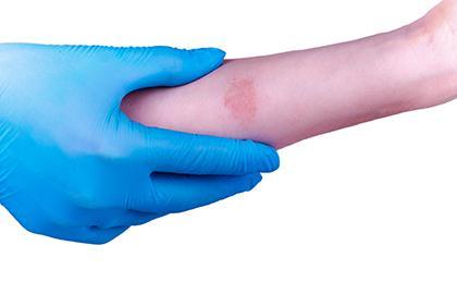 Skin Rash