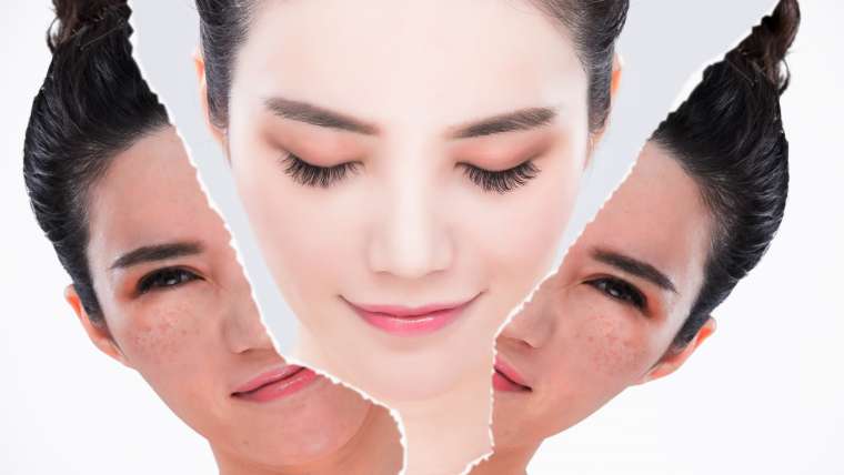 Acne Treatment
