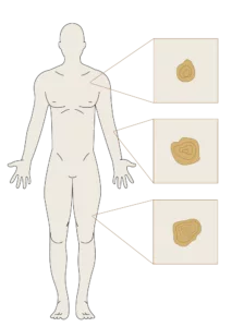 Identifying Skin Cancer